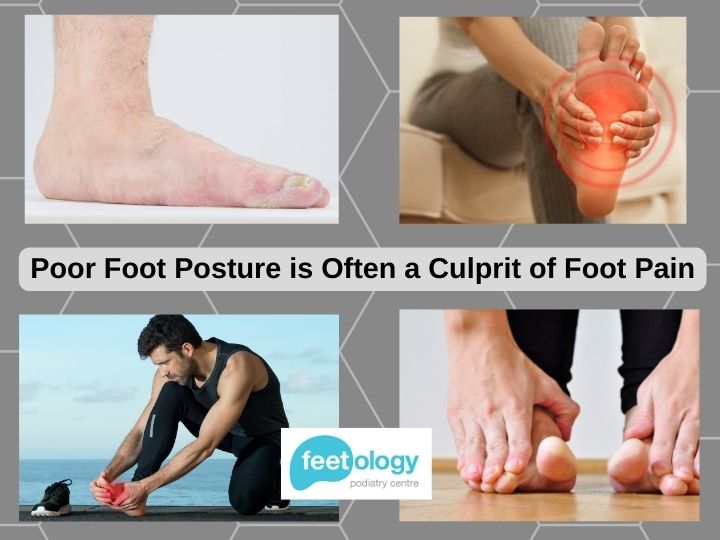 Foot Posture: The Surprising Link That Can Cause Foot Pain - Feetology ...